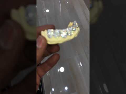 Custom Diamond Grills 10 top 10 bottom